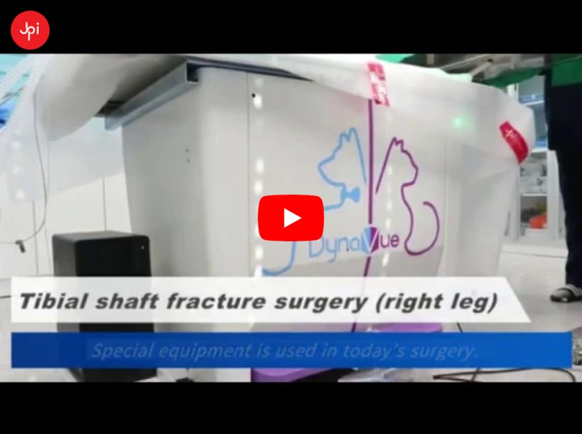 DynaVue: Tibial Shaft Fracture Surgery on Right Leg
